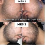 Minoxidil 15% o mais Concentrado de João Pessoa